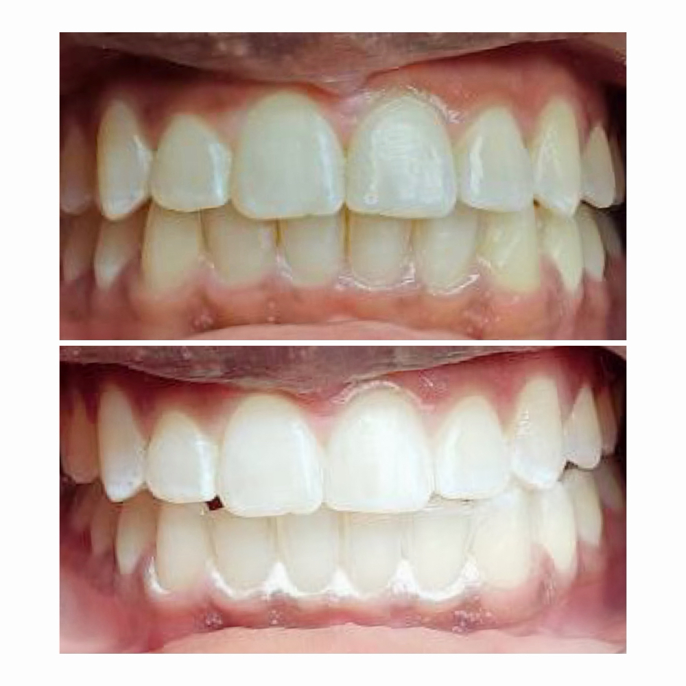 Professional Teeth Whitening at Haus of Beauty Studio in Hialeah, FL