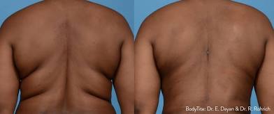 Men Body Sculpting