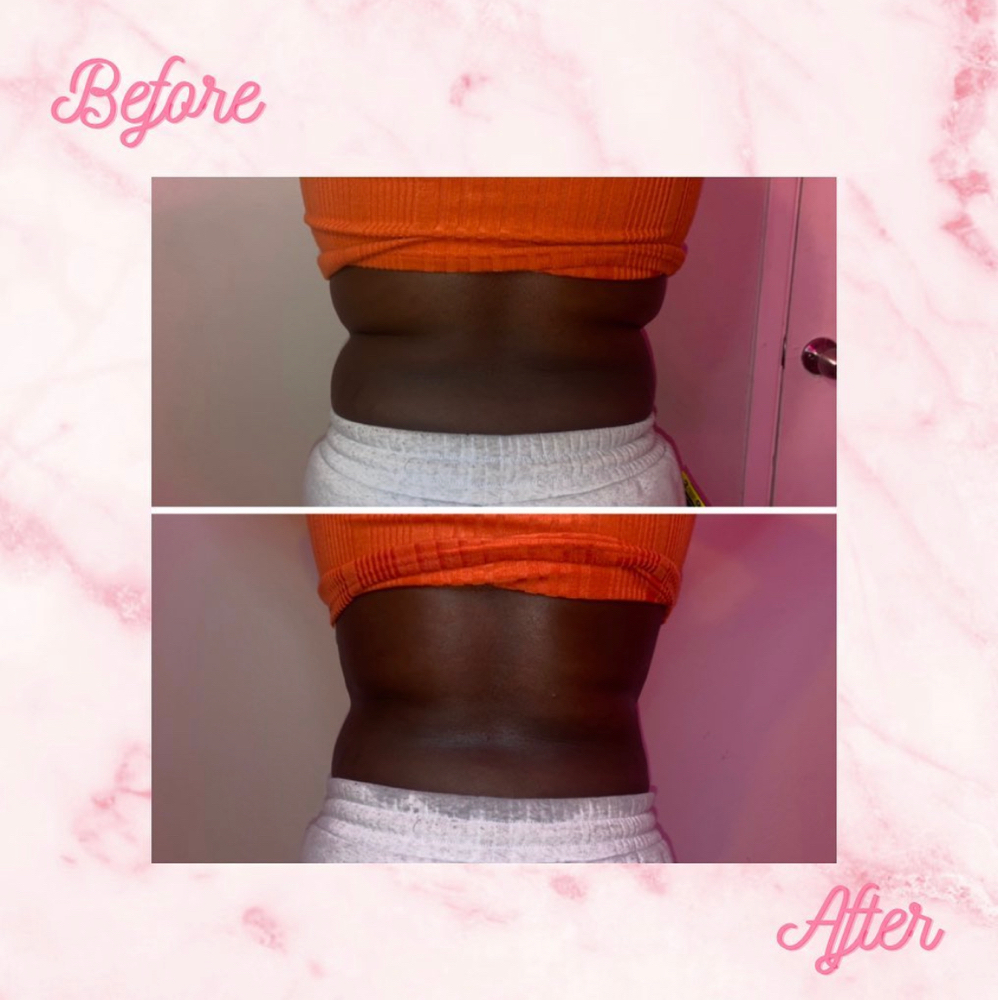 Lipo360