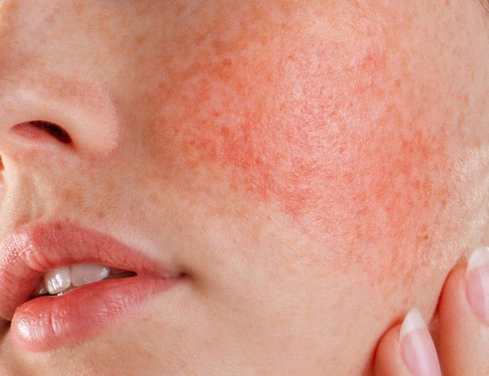 Calm & Restore Facial ( Rosacea)