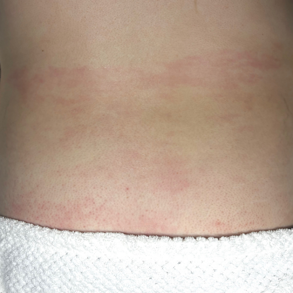 Lower Back Wax at Pearly Derm in Sun valley, CA