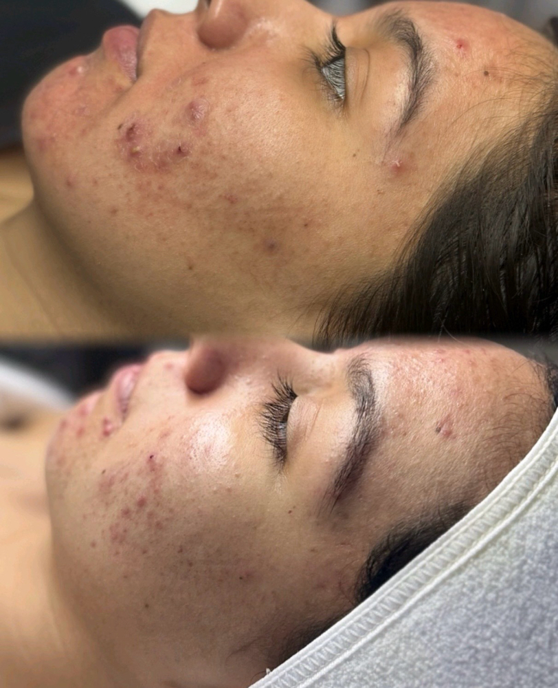 Acne Bootcamp Treatment, Bi-weekly