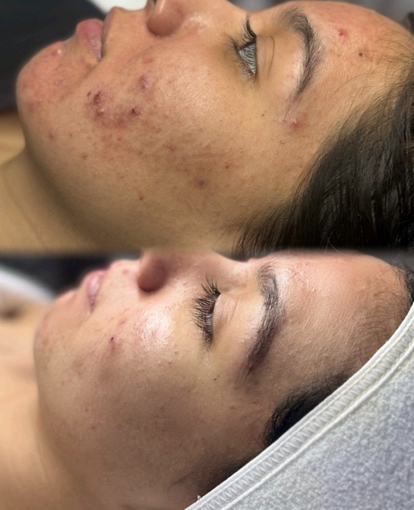 12 Weeks- Acne Bootcamp Treatment at Rêvelite Aesthetics in Temecula, CA