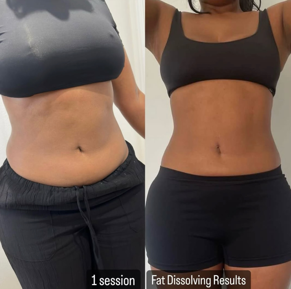PCDC Liquid Lipo Dissolve