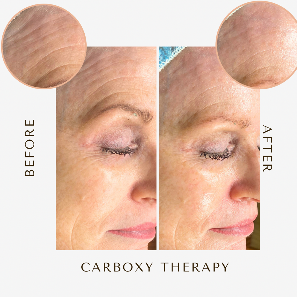 Add-on Korean Carboxy Treatment