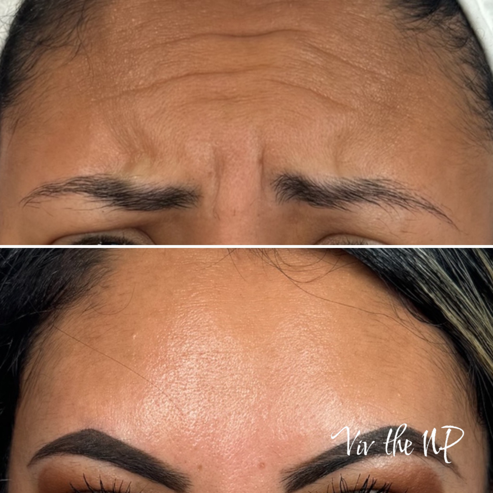 Xeomin (pure botox) 10/unit