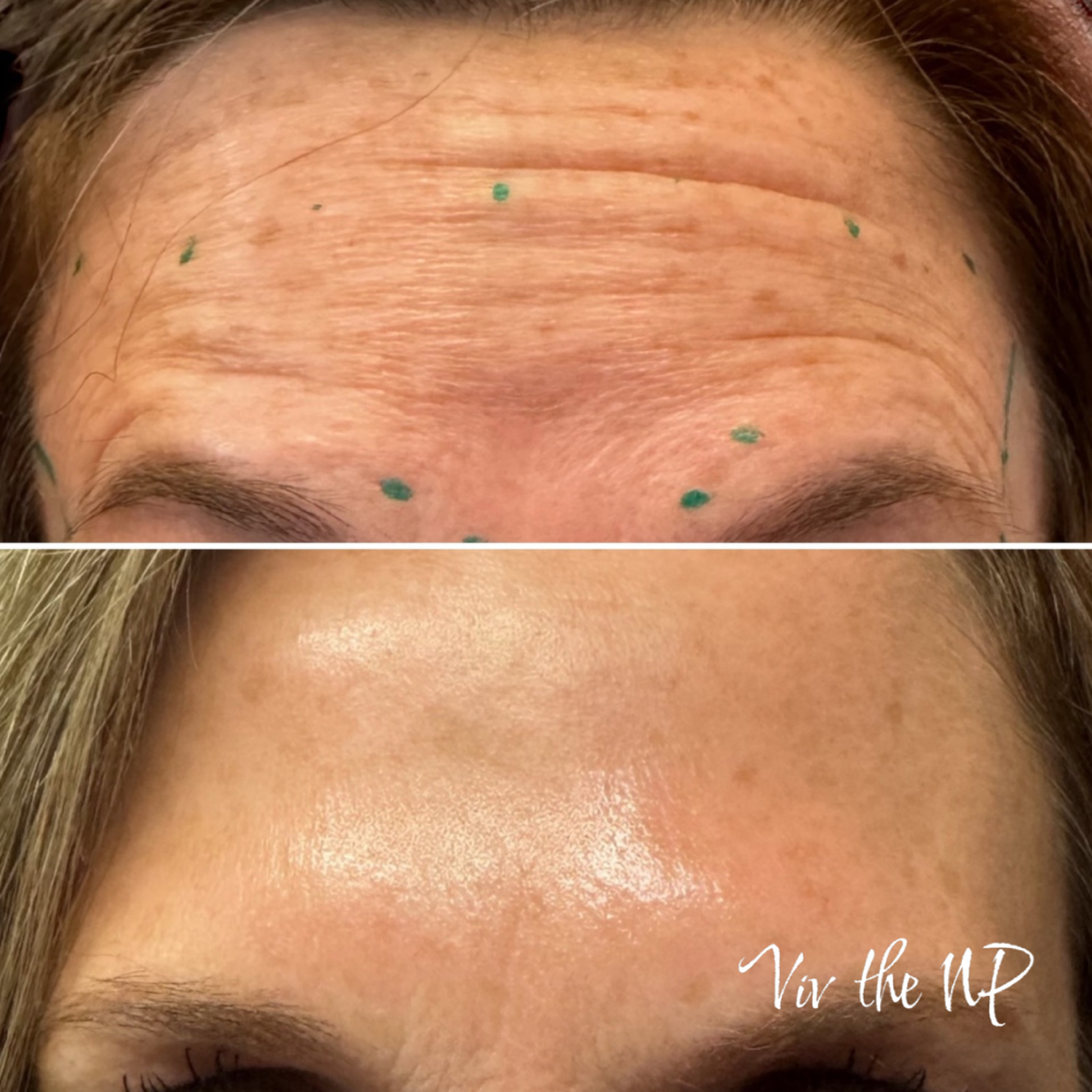 Xeomin (pure botox) 9/unit