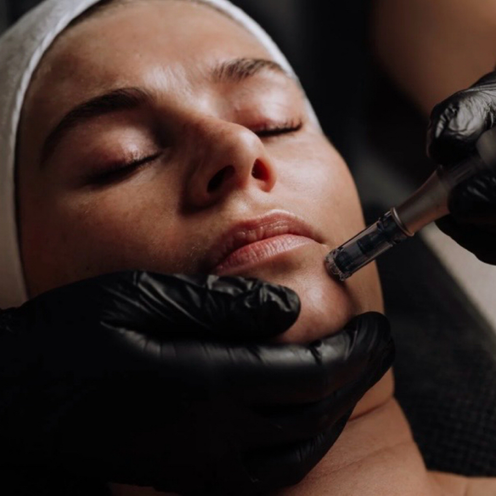 Microneedling at Skn2Skn Aesthetics in Chicago, IL