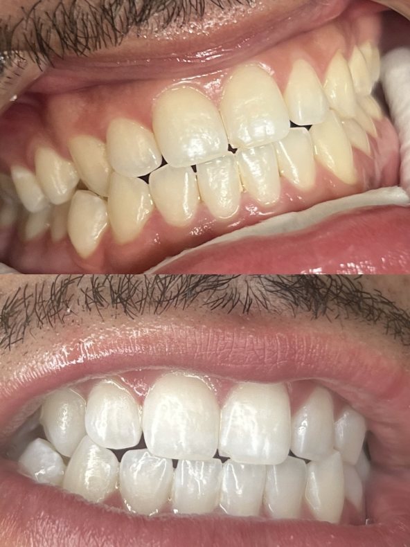 Teeth Whitening 90 Min