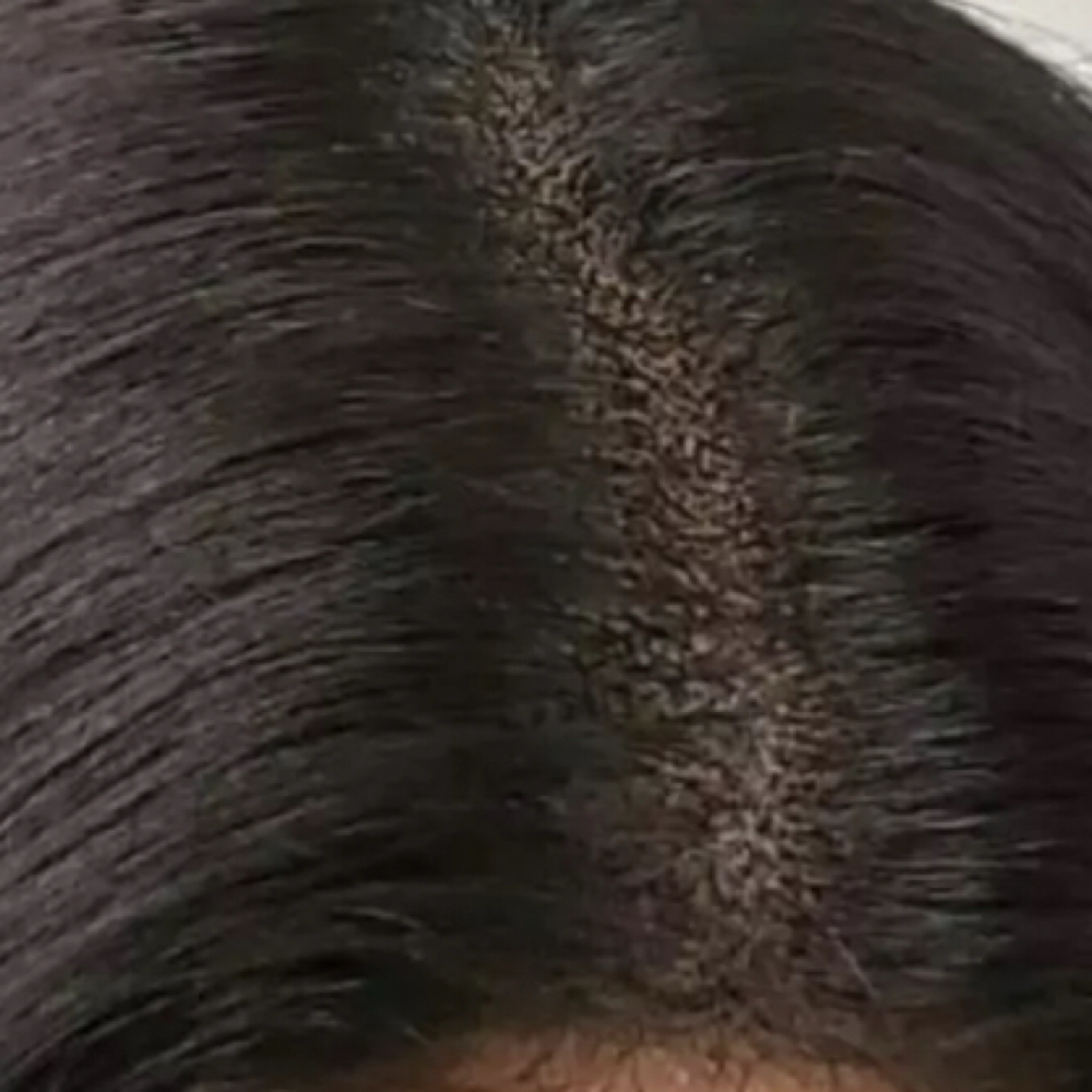 Scalp Micropigmentation at Vanity Brows & Skin in Bridgeport, PA