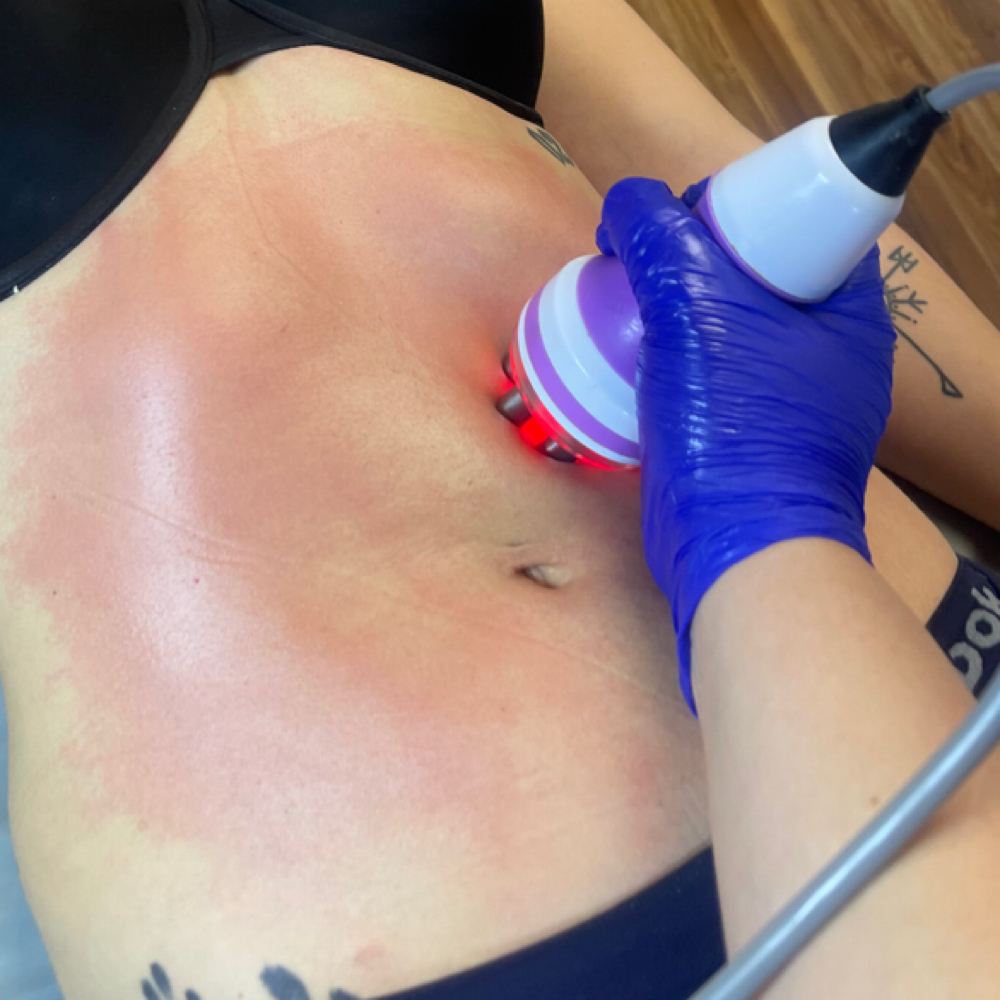 1 Post Op Lipo Surgery massage at Blush in Comfort in Wilbraham, MA