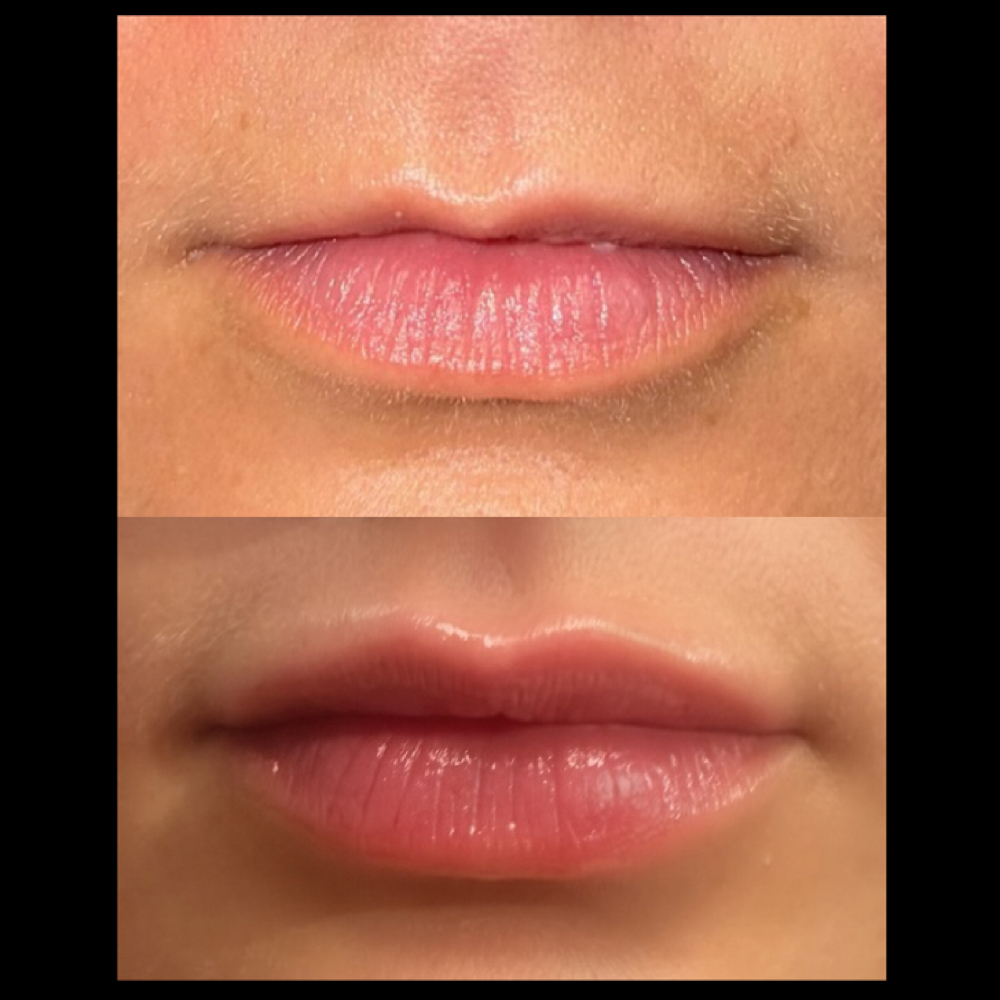 Baby Plump at Injections by Leighanna in Clarksville, IN