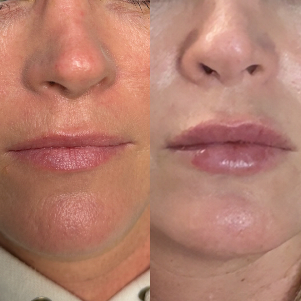 Baby Plump; 1/2 Syringe Lip Filler at Injections by Leighanna in Clarksville, IN