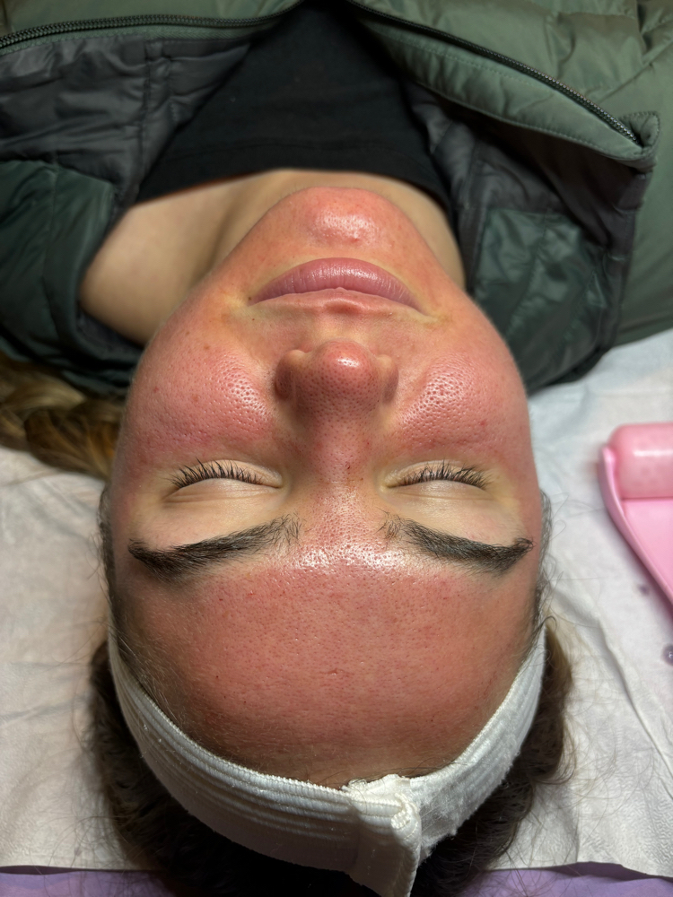 Micropeel