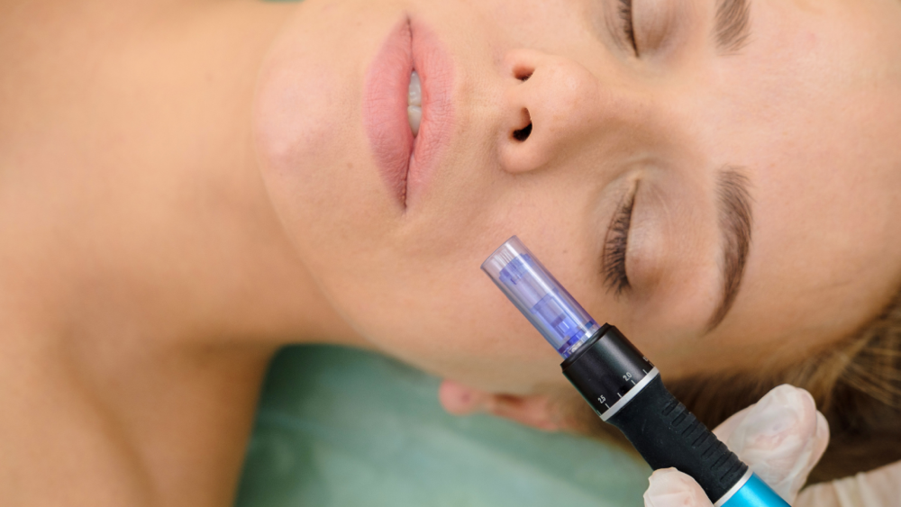 Microneedling at Anointed Aesthetics in Pasadena, TX