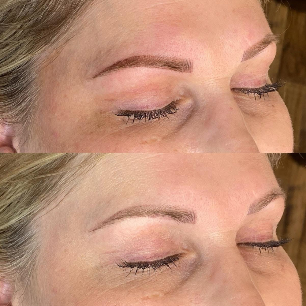 Brow Follow Up 4-6 Weeks