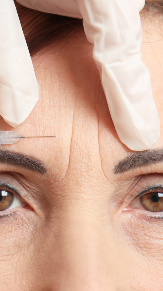 Glabella Lines (11s)