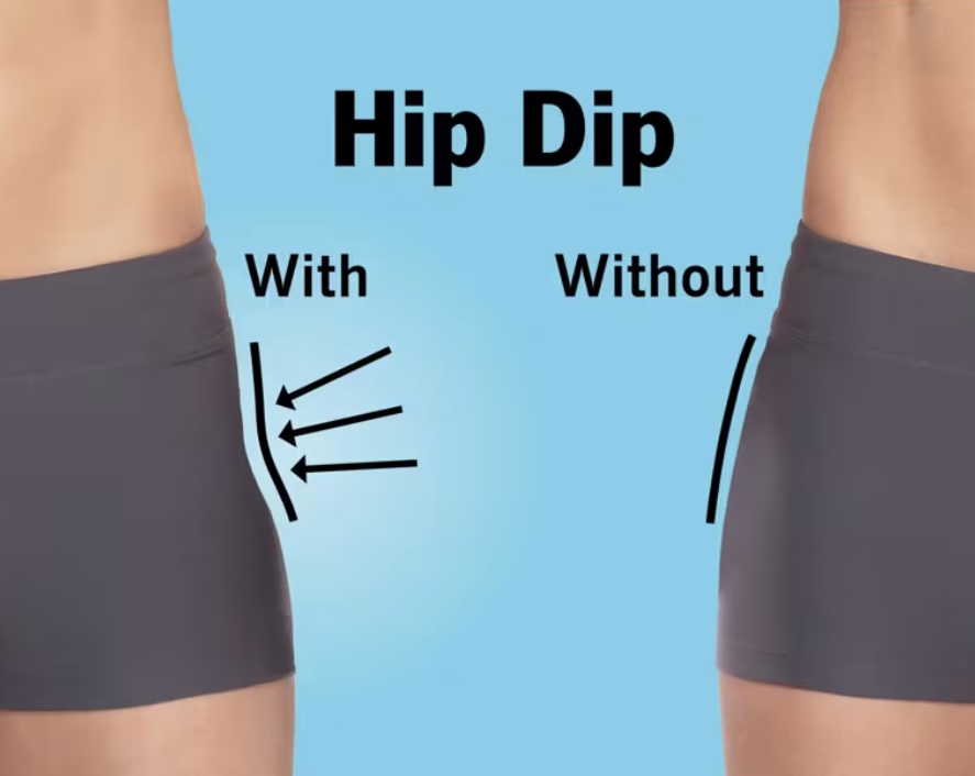 Hip Dip Reduction