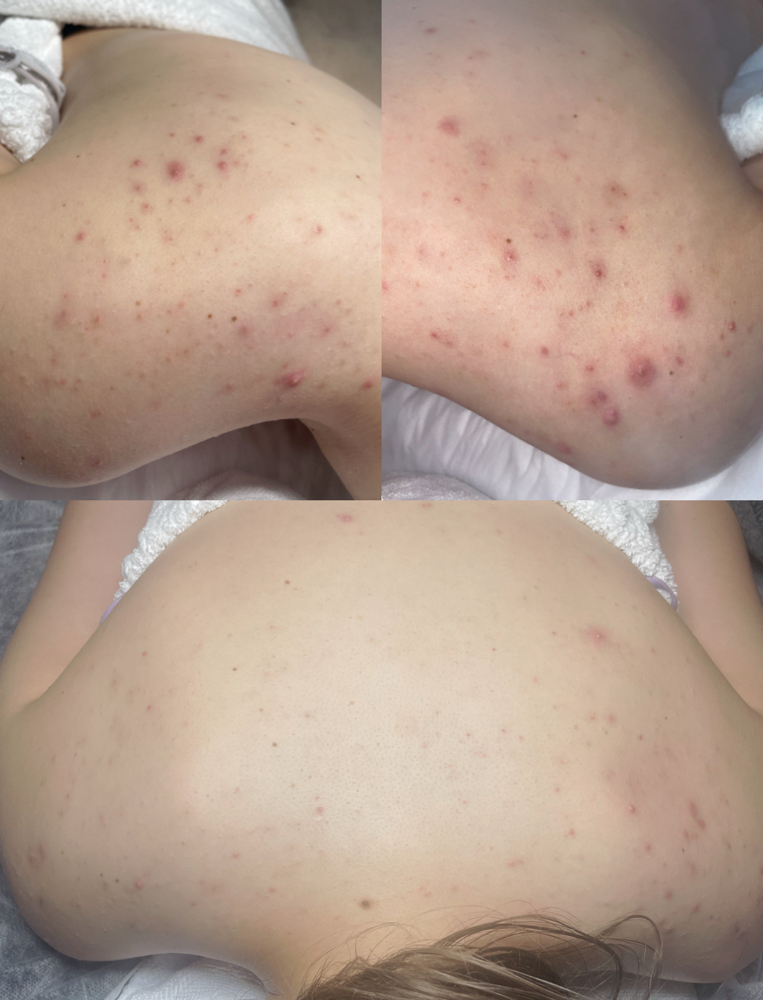Custom Back Facial