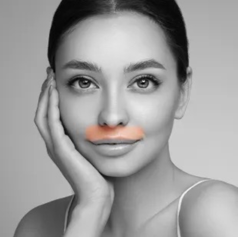 Upper Lip-Six Sessions