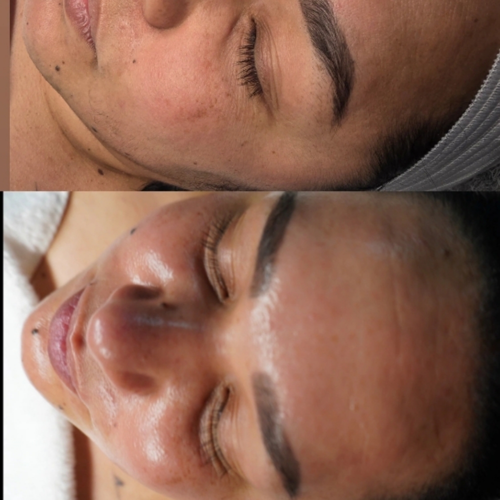DERMAPLANING TREATMENT at Palomabeautyglow in Smithtown, NY