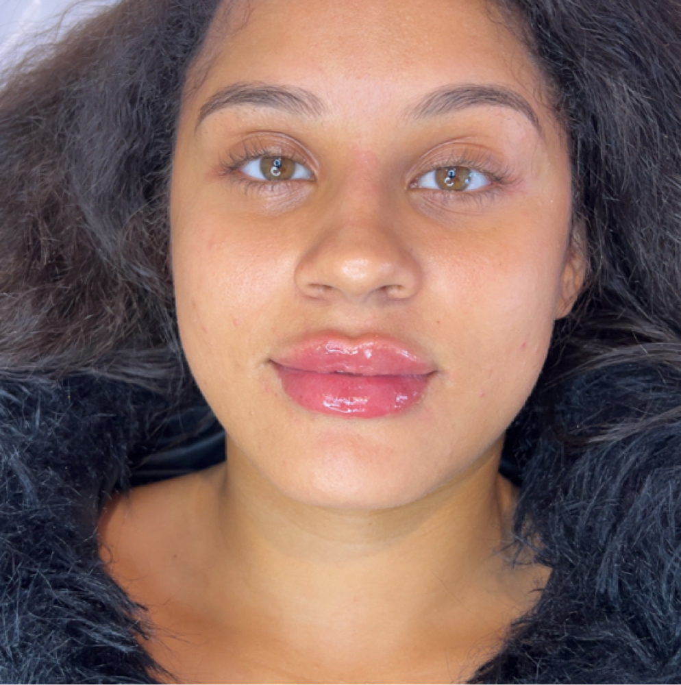 Lip Filler Model Call at Benlux Aesthetics in Alexandria, VA
