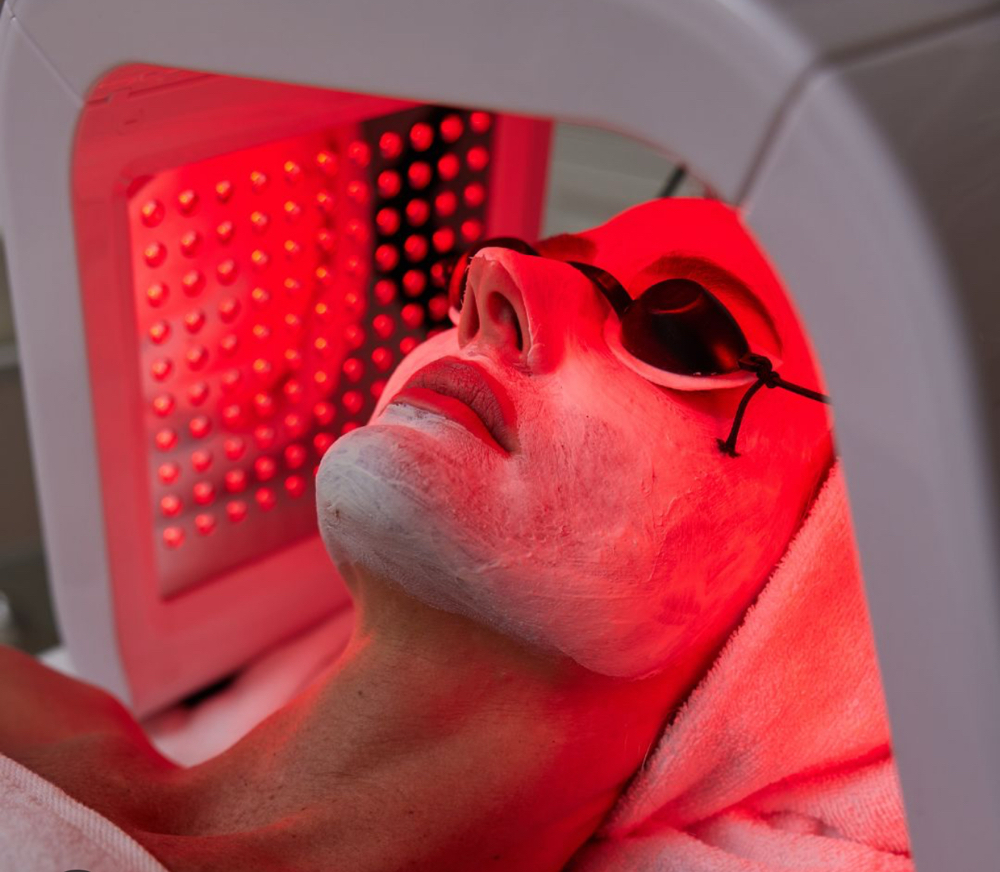 Non-surgical Face Lift