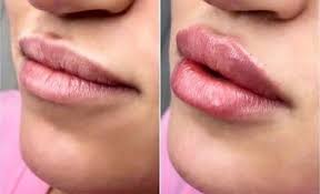 KISSY POO LIP FILLERS ~ 1.5 ML