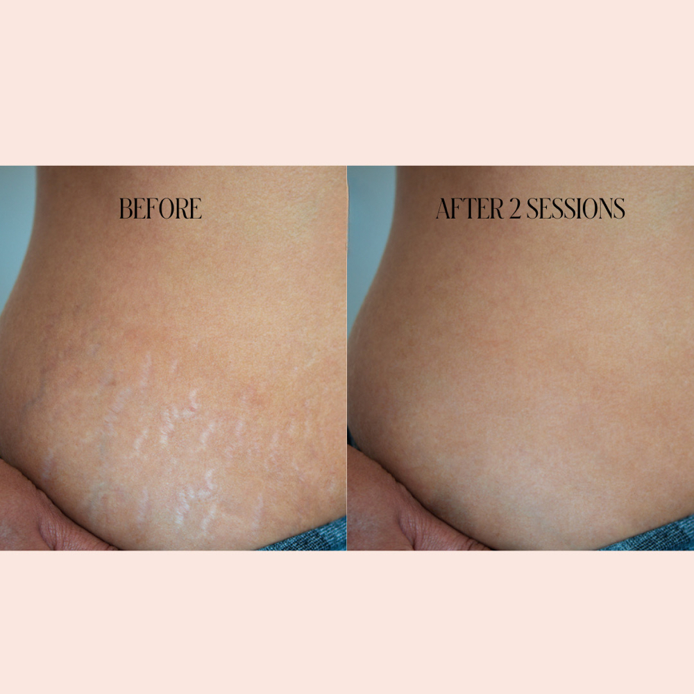 Inkless Stretchmark Invision