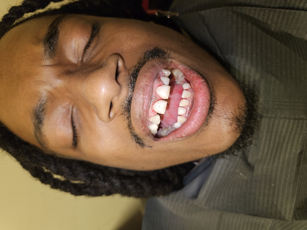 Gold Grill Removal Per Tooth
