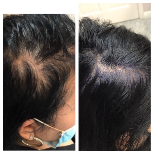 HAIR LOSS RESTORATION