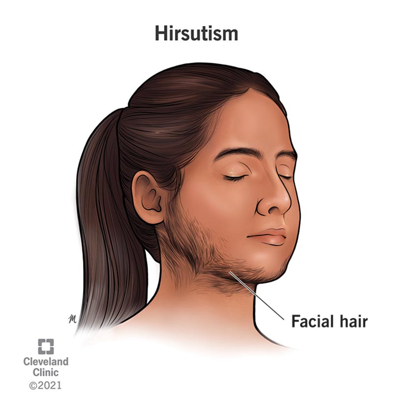 Hirsutism Chin Wax