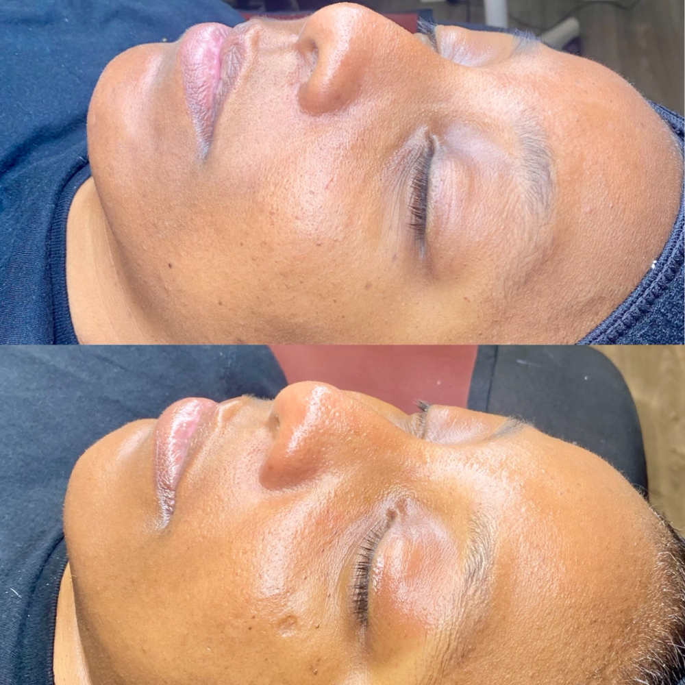 Neechs Facial at Justt a tad esthetics in Fresno, CA