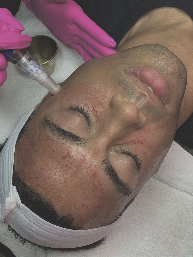 Microneedling
