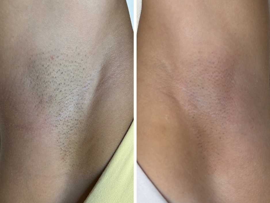 Hair Removal