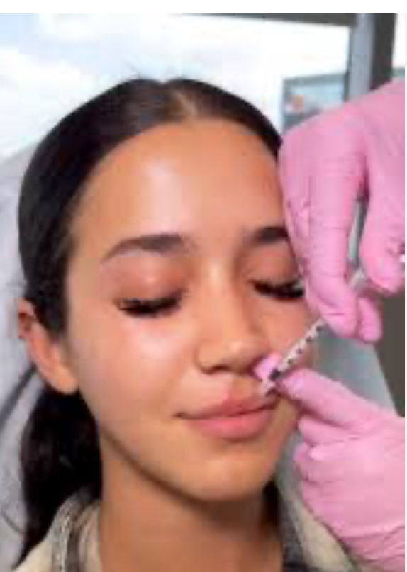 Filler 1ml