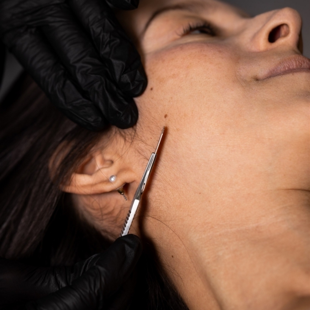 Dermaplaning at Renewed Essence Aesthetics and Wellness in San Antonio, TX