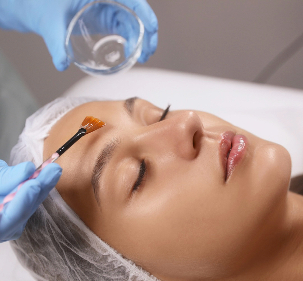 Chemical Peel