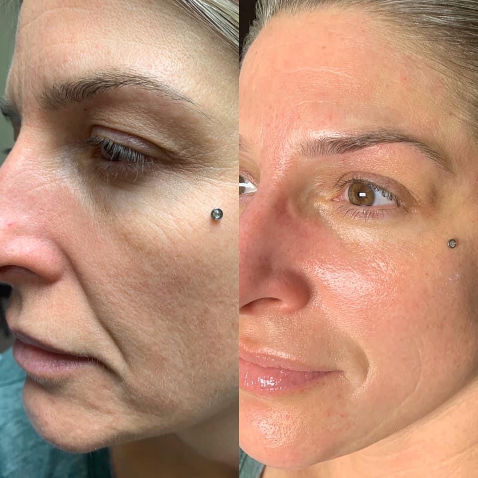 Dermaplaning With Mini Facial