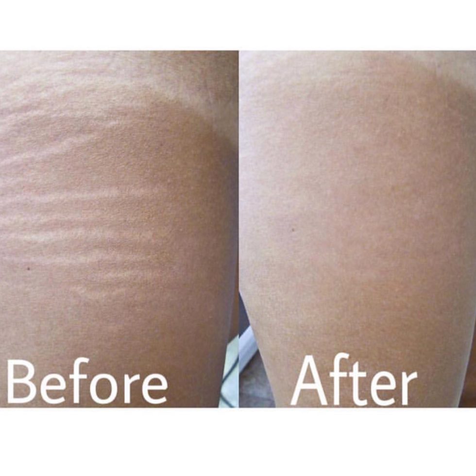 Inkless Stretch Mark & Scar Rev.