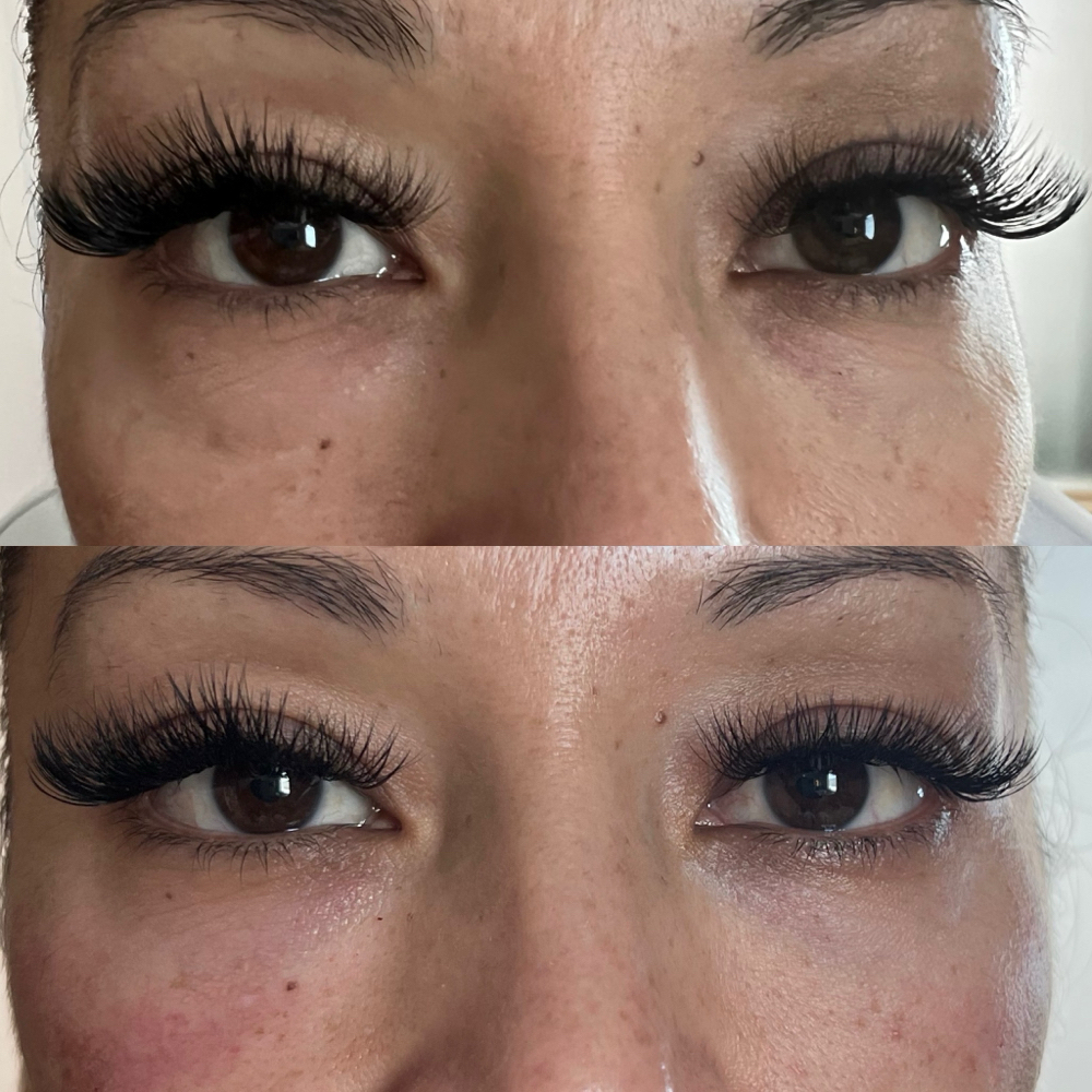 PRP Under-eye Rejuvenation at Refyned Aesthetics & Wellness in Greenville, TX