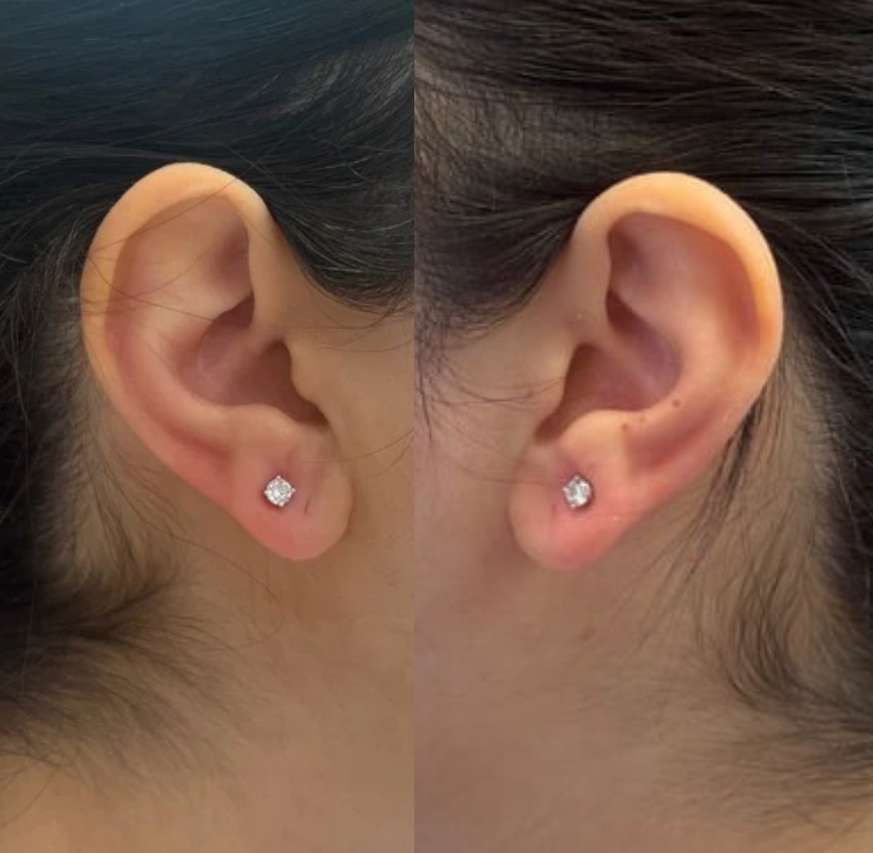 Piercing - Ear Lobes