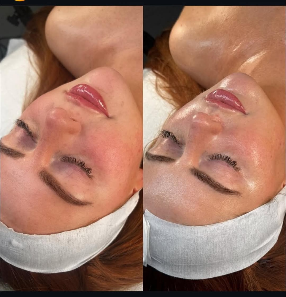 The Euphoria Facial