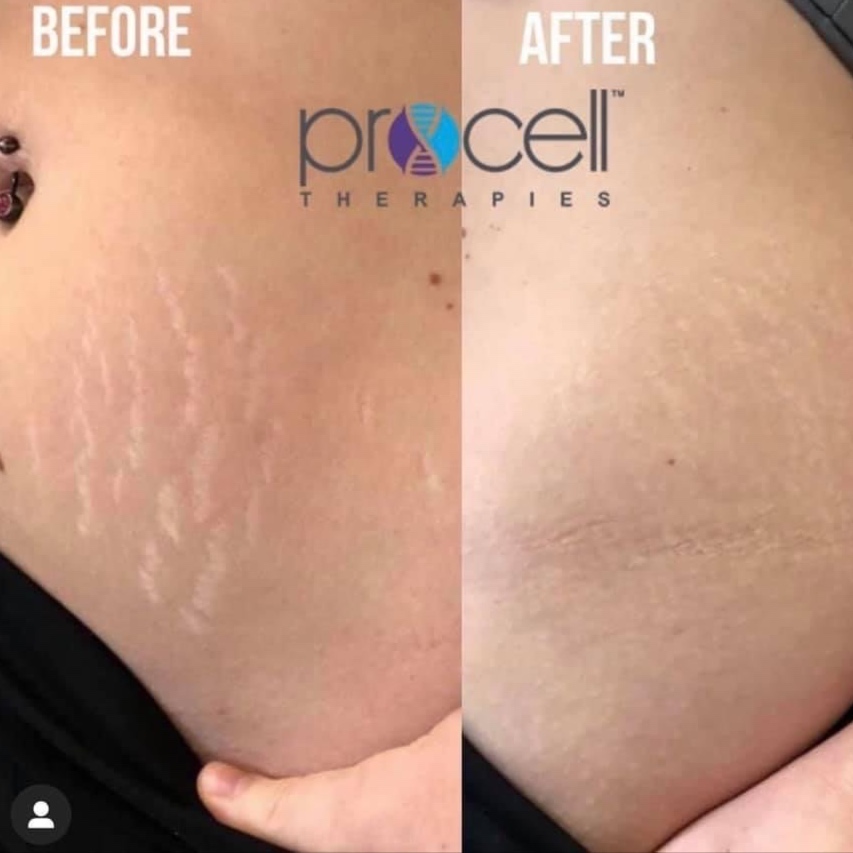 Microneedling (Body Part) at SoLuna Aesthetics in Scottsdale, AZ
