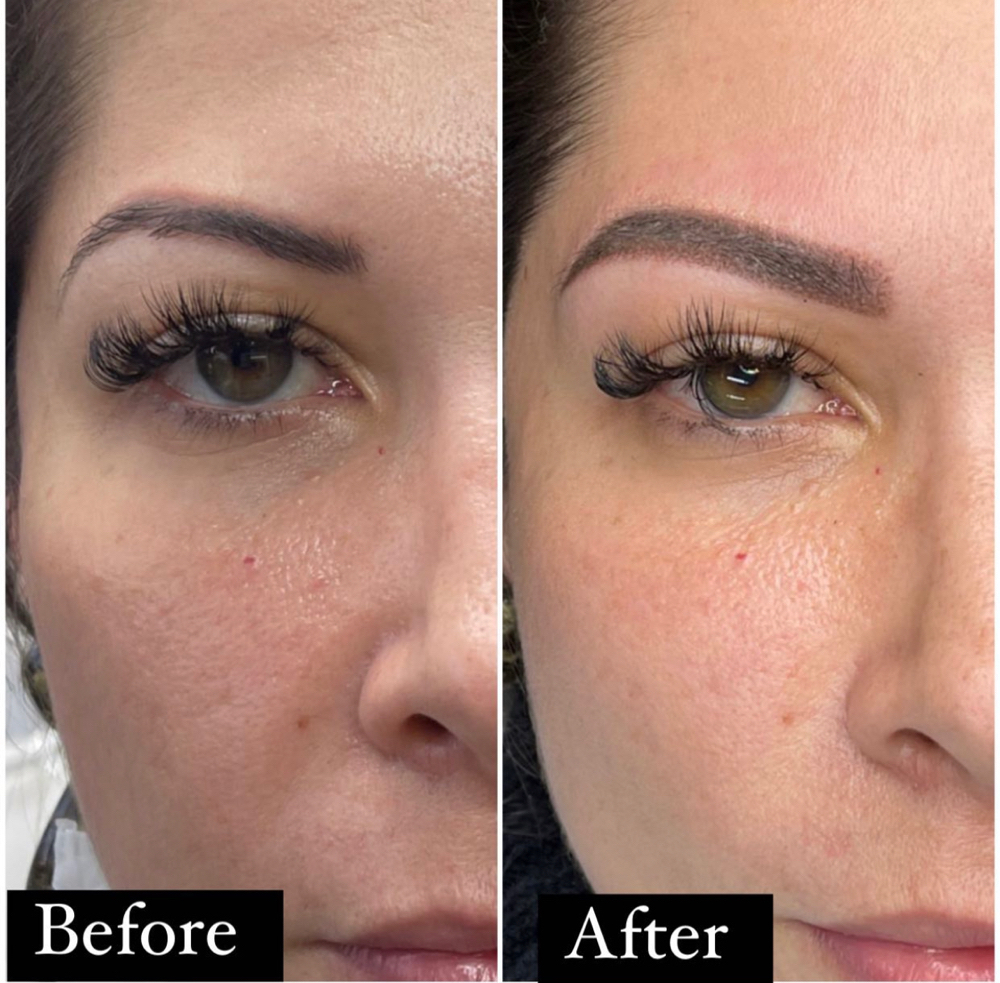 Eyebrow Corretion (SOS)
