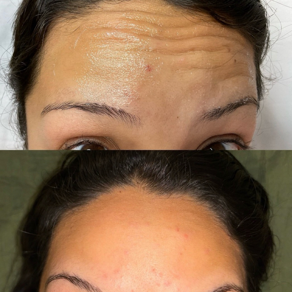 Neurotoxin Injections $8/Unit at Sittin’ Pretty Headspa & Aesthetics in Corpus Christi, TX