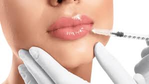 Lip Filler