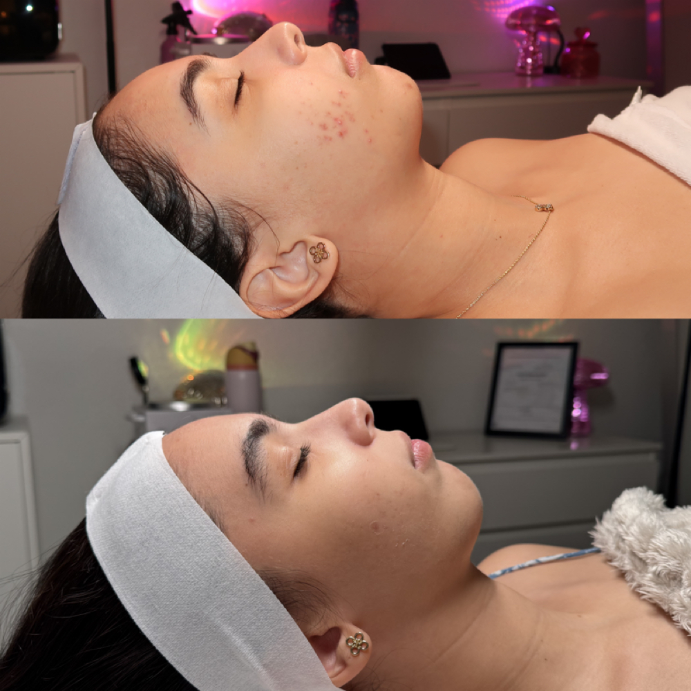 ESB Acne Program ⊹♡ at Elara Skin Bar in Carolina, PR