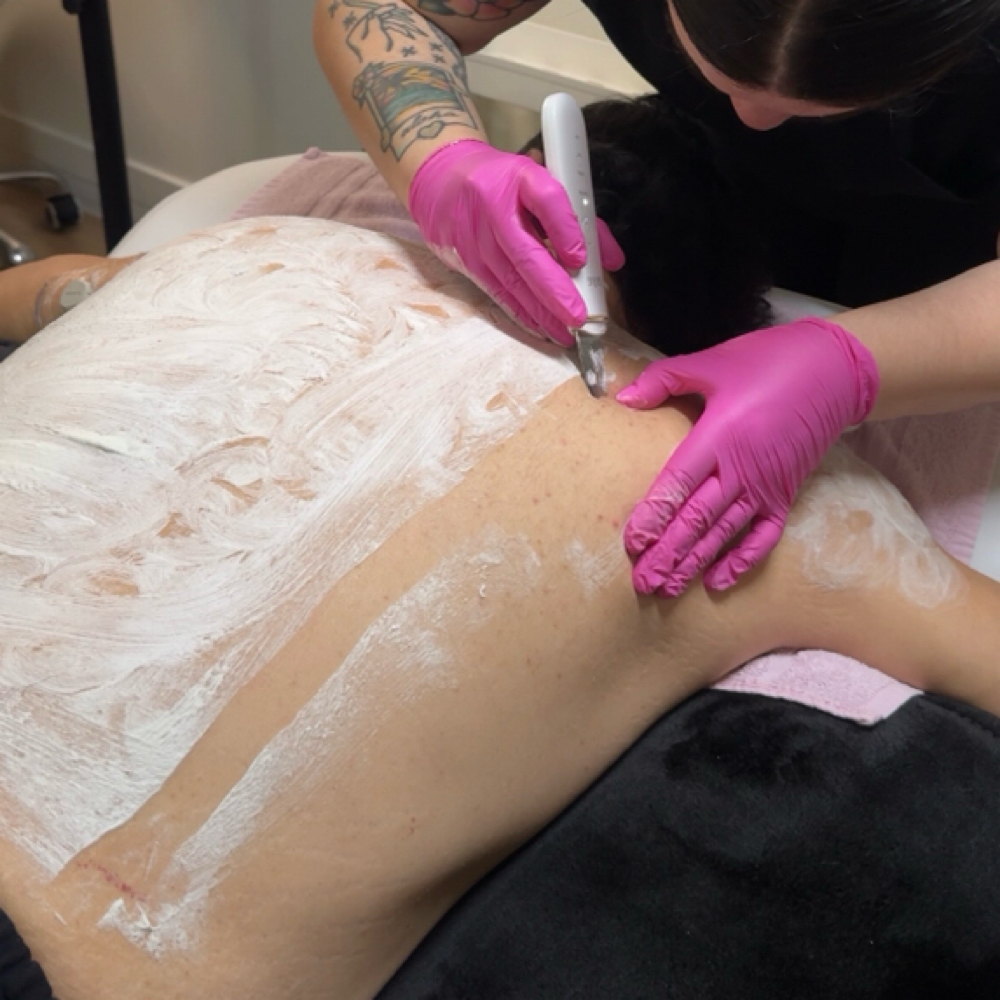 Back Facial at Velvet Beauty Aesthetics in Salt Lake City, UT