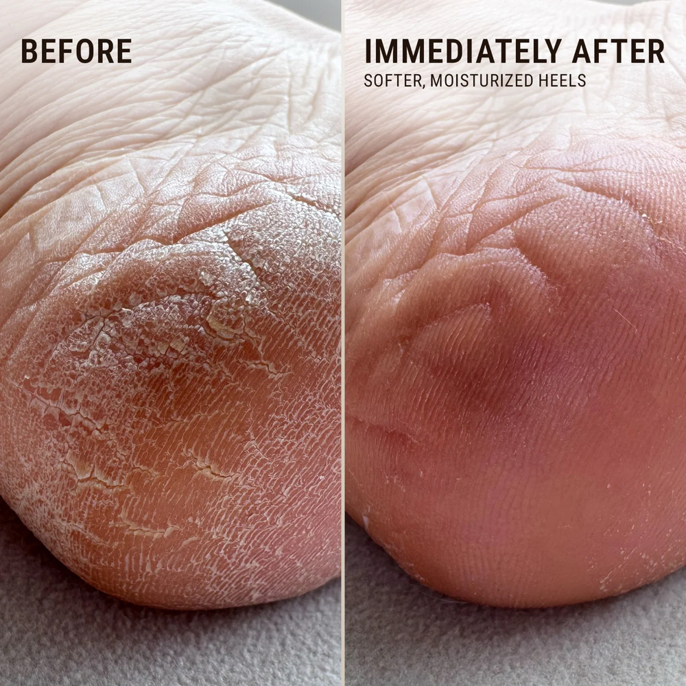 Ultimate Heel Rescue at Be Flawless Esthetics & Nails in Erie, PA